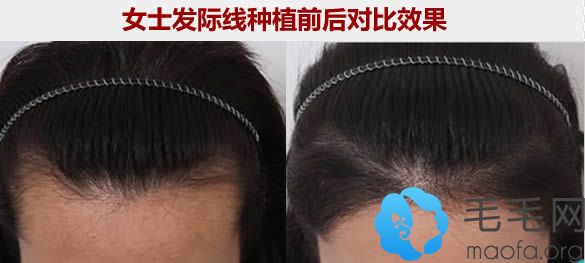 西宁韩美植发中心发际线种植案例
