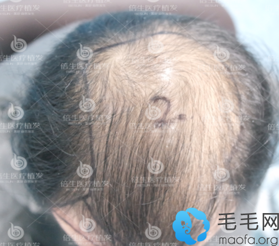 大面积脱发男士来验证广州倍生植发坑不坑