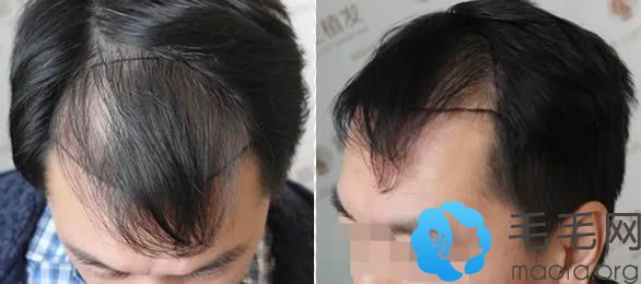 在武汉新生植发做毛发移植术前照