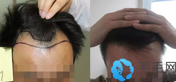 M脱发男士在北京雍禾种植发际线前后对比效果图