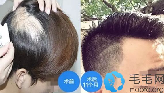 在北京雍禾种植2100单位给头顶疤痕植发案例对比照