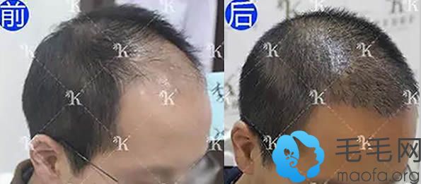 北京科发源五级脱发植发前后对比照