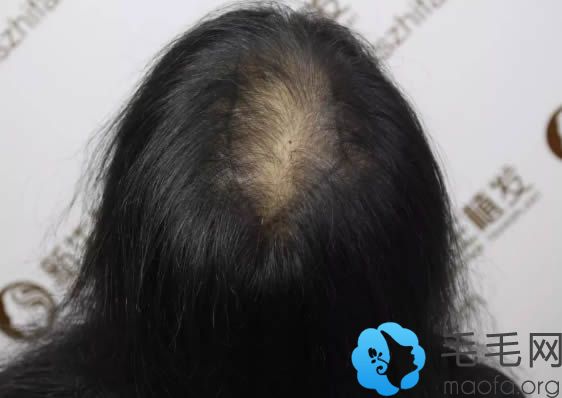 郑州新生植发怎么样?女性头顶加密种植案例及3个月效果赏析