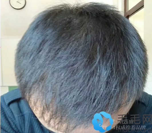 在南宁碧莲盛植发种植头发10个月恢复效果