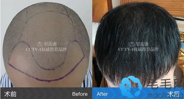 四级脱发在碧莲盛种植头发一年后效果对比图