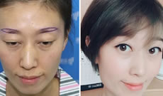 我是青岛雍禾植发医生 现发表植眉6个月后的效果和感言
