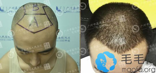 M+O型脱发男士在广州荔医做头发种植的案例