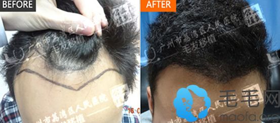 M发脱发男士在广州荔医植发做发际线种植案例前后效果对比