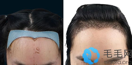 发际线偏高女性在重庆莱森植发做发际线种植案例