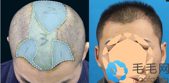 4级M型脱发男士在重庆莱森种植案例