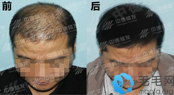北京中德头发稀疏加密案例及前后对比效果