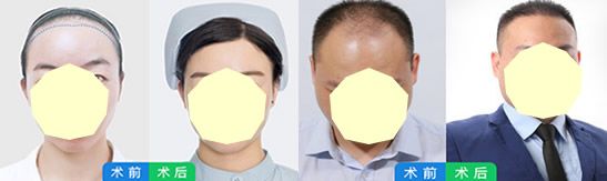 广州曙光植发怎么样，靠不靠谱？看发际线种植+头发种植案例效果