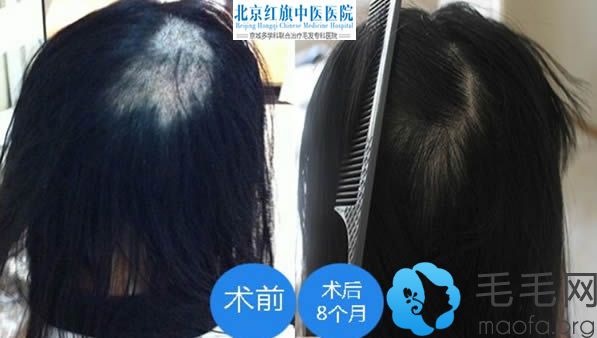 北京红旗中医医院疤痕植发案例及8个月恢复效果图