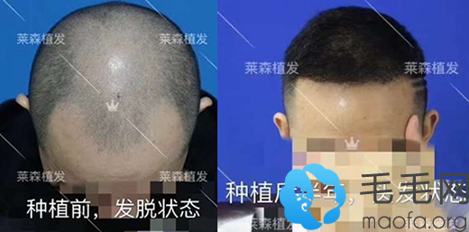 M型脱发男士在重庆莱森做发际线种植案例