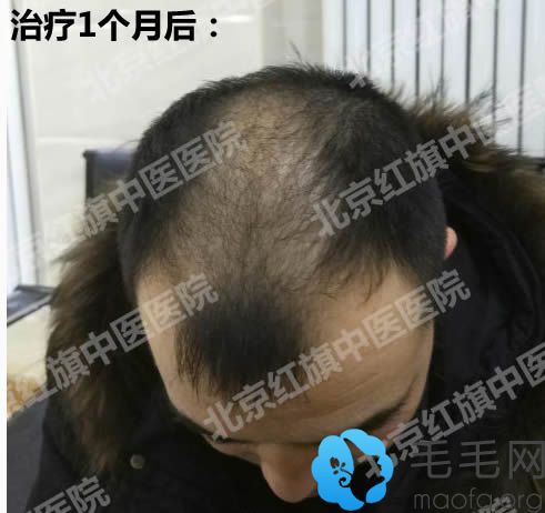 在北京红旗中医医院让李素花治疗脱发一个月效果