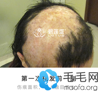 北京碧莲盛疤痕植发真人案例来用验证：疤痕植发能做吗