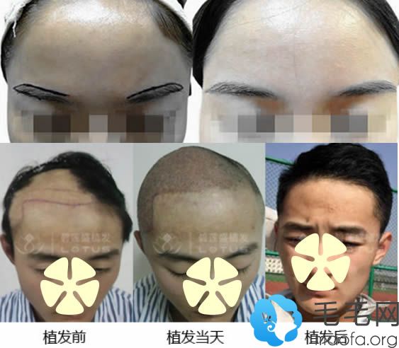 南京碧莲盛男士植眉效果图及疤痕植发案例