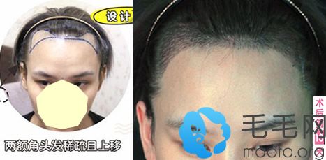 M型脱发患者找广州韩妃赵进做发际线种植案例