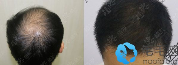 四级脱发的张先生在广州植德医院种植头发效果