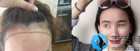 广州植德植发女生发际线种植10个月后效果