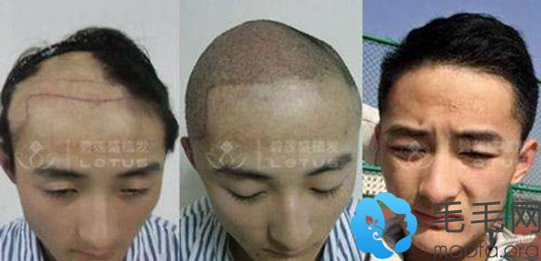 北京碧莲盛疤痕植发前后效果对比图