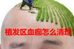 北京雍禾科普 怎样去掉植发区的血痂+植发后后脑勺疼怎么办