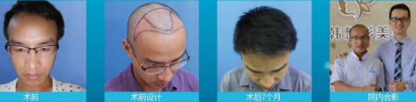 M型发际线及头顶稀疏加密种植案例及术后7个月恢复效果