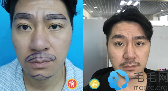 北京南加医院种植眉毛和胡须案例效果
