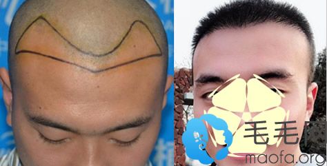帅哥M型脱发在南京雍禾种植发际线案例