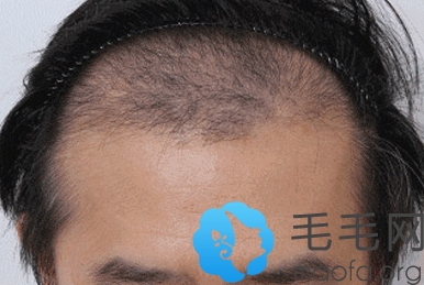 海南华美种植头发3个月脱落期图