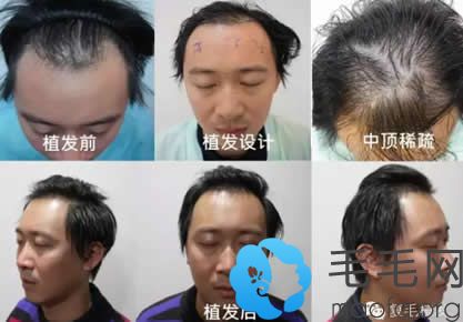 上海复毛植发一年前后效果对比案例