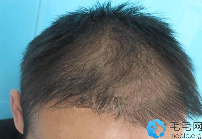 植发后没有做养固处理，头发脱落导致断层