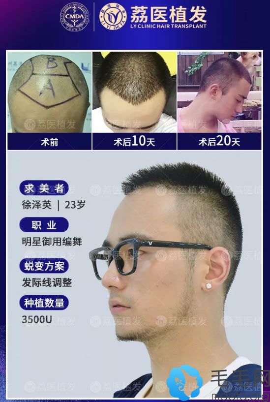 广州荔医植发男性植发案例