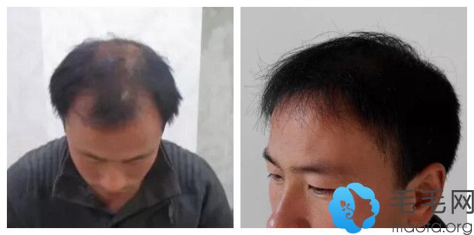 北京瑞丽诗5级脱发种植4000单位毛囊9个月效果图