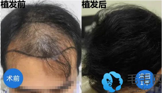 在上海碧莲盛植发10个月前后对比效果