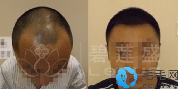 北京碧莲盛五级脱发种植头发2500单位一年后效果对比案例