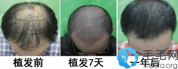 五级脱发男士在北京瑞丽诗植发4000毛囊单位一年后效果