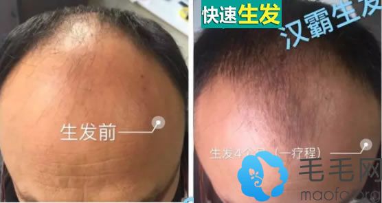52岁的张先生使用汉霸生发液4个月的对比效果