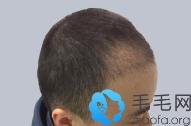 在北京碧莲盛做头顶植发两个月了