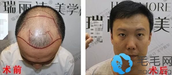 杭州瑞丽诗植发头顶稀疏加密植发前后效果对比案例