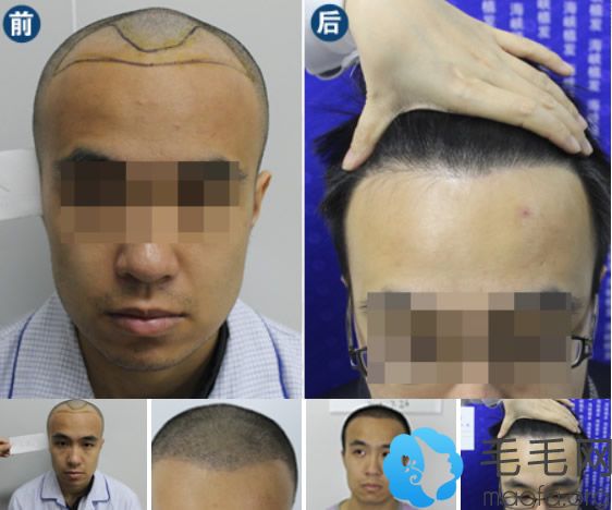 济南海峡植发男士发际线种植案例