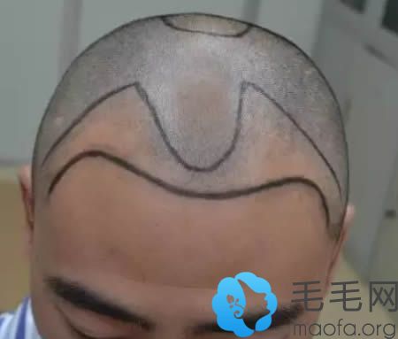 唐先生在桂林华美种植头发术前照