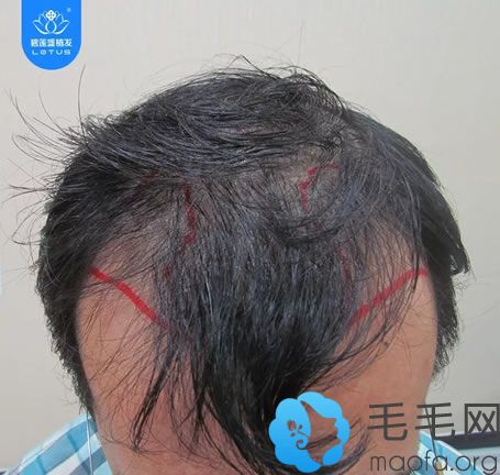 m型发际线一定会秃顶吗？杨先生分享植发挽救秃顶命运过程