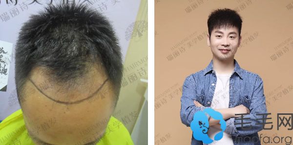 杭州瑞丽诗种植发际线和头顶加密植发一年前后效果对比