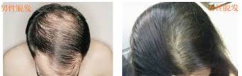 女性脱发和男性脱发的区别