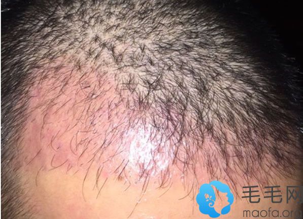 北京植发哪个医生好 想问植发二个月植发区发红是怎么回事