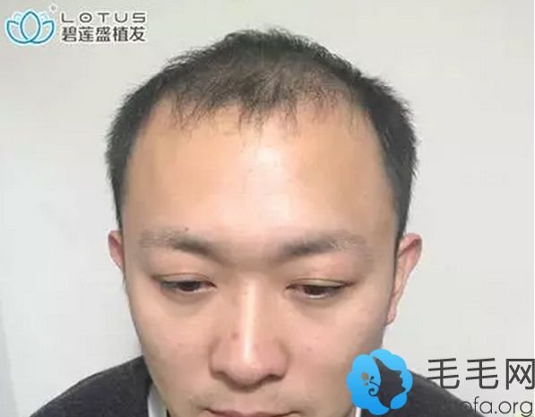 上海碧莲盛种植发际线两个月效果图