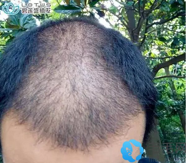 额角植发+头顶加密植发一个月效果图