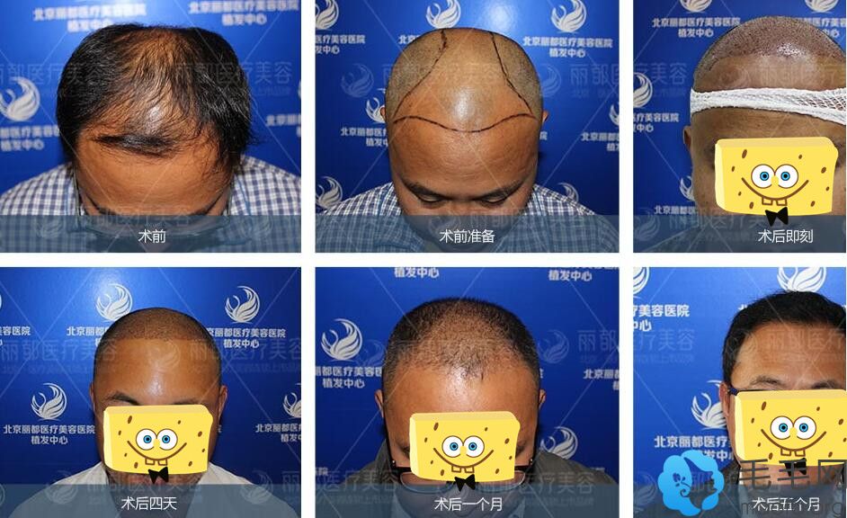 男士在北京丽都做头顶稀疏加密种植案例恢复过程