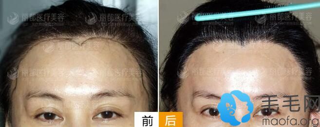 女性在北京丽都做头顶稀疏加密种植案例